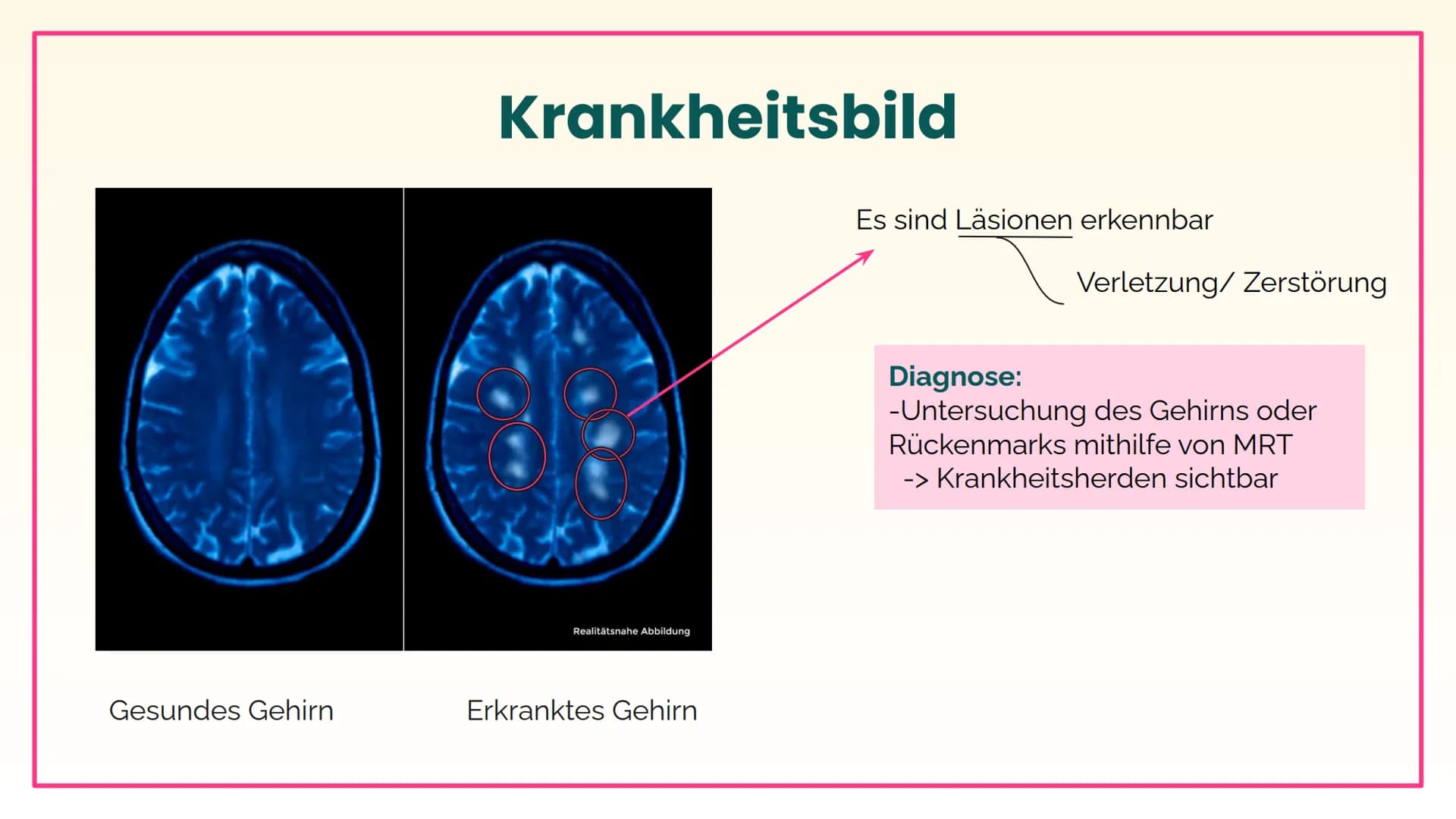 Multiple
Sklerose und
Parkinson
Lisa und Mia 01
Multiple Sklerose
Inhalt
02
Parkinson 01
Multiple Sklerose
Krankheitsbild bis Behandlung Was