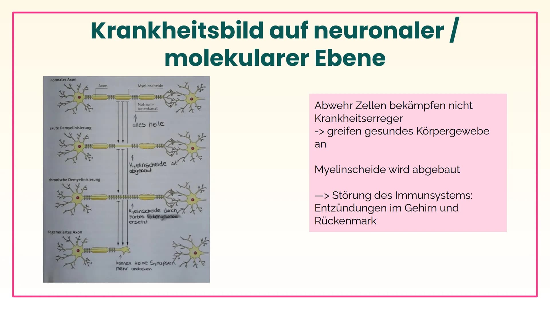 Multiple
Sklerose und
Parkinson
Lisa und Mia 01
Multiple Sklerose
Inhalt
02
Parkinson 01
Multiple Sklerose
Krankheitsbild bis Behandlung Was