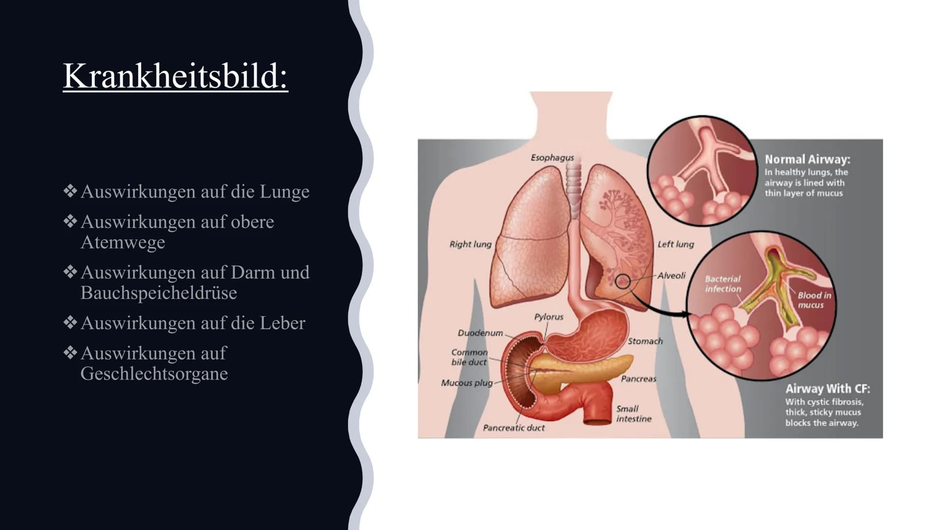 Mukoviszidose
Von Celine und Nisa Gliederung:
Definition
*Symptome
Ursachen
Krankheitsbild
*Vererbung
*Lebenserwartung/Vorkommen
Die Verschi