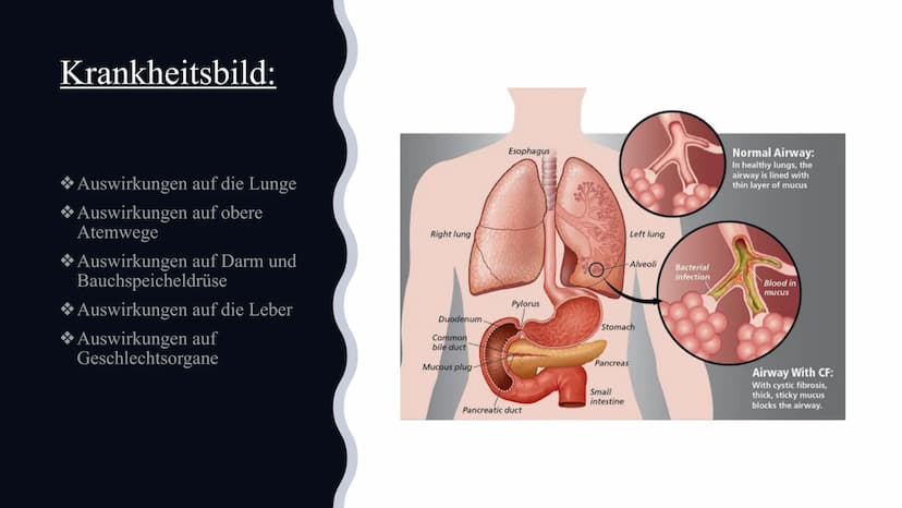 Mukoviszidose
Von Celine und Nisa Gliederung:
Definition
*Symptome
Ursachen
Krankheitsbild
*Vererbung
*Lebenserwartung/Vorkommen
Die Verschi