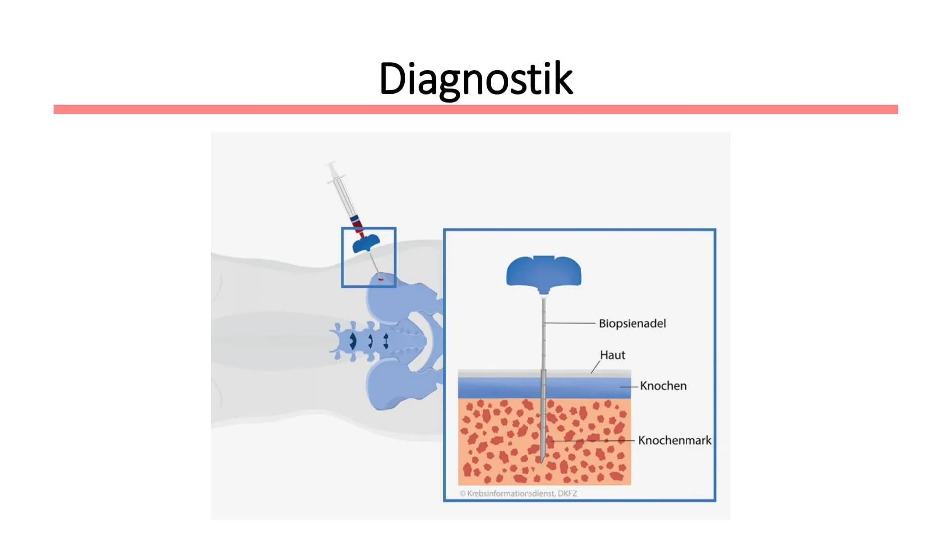 Leukämie
Biologie / Klasse / Name / Datum ●
Symptome
• Diagnostik
Therapie
Allgemein
Wen betrifft es?
●
Gliederung
Autologe Stammzelltherapi