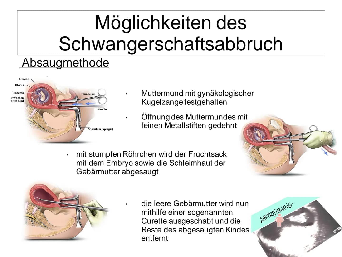 Schwangerschaftsabbruch
T
BERATUNGSPFLICHT
MULTIERZY
VERURTEILUNG
BELL
GYNÄKOLOGEN
ZEITDRUCK Schwangerschaftsabbruch
Gliederung:
• Allgemein