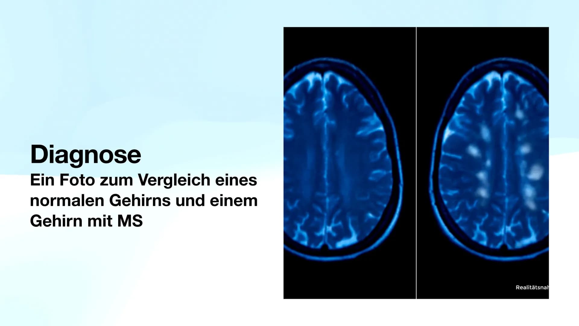 Multiple Sklerose
Biologie-GK Präsentation
Von Sarah Inhaltsverzeichnis
●
●
●
●
●
●
●
●
Allgemeines
Verlaufsformen
Symptome
Diagnose
Therapi
