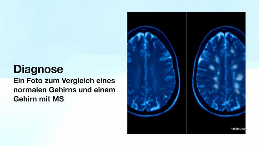 Multiple Sklerose
Biologie-GK Präsentation
Von Sarah Inhaltsverzeichnis
●
●
●
●
●
●
●
●
Allgemeines
Verlaufsformen
Symptome
Diagnose
Therapi