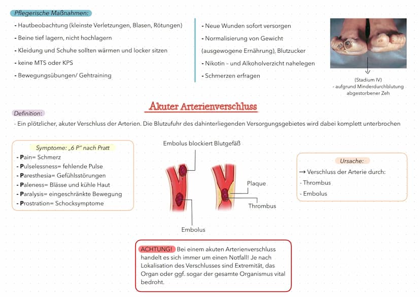 PAVK/AVK
- mit Komplikation akuter Arterienverschluss
Definition: - chronische Verengung bzw. Verschluss der Extremitäten und daraus folgend