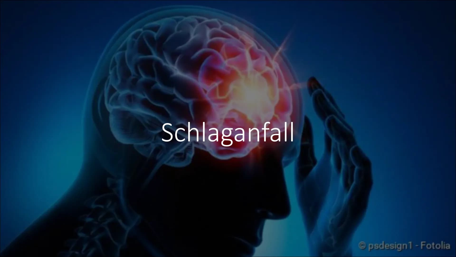 H
Schlaganfall
psdesign1 - Fotolia Was ist ein
Schlaganfall
und welche
Ursachen gibt
es?
Lateinisch: ,,Apoplex" genannt
Ist eine Erkrankung 