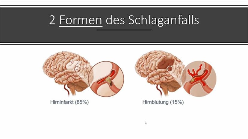 H
Schlaganfall
psdesign1 - Fotolia Was ist ein
Schlaganfall
und welche
Ursachen gibt
es?
Lateinisch: ,,Apoplex" genannt
Ist eine Erkrankung 