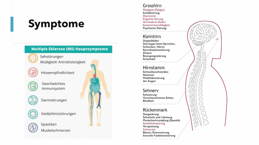 Multiple Skelrose (MS)
Die Krankheit der tausend Gesichter Gliederung
1. Allgemeine Fakten
2.
Was ist MS?
3. Was passiert bei MS?
4.
Ursache
