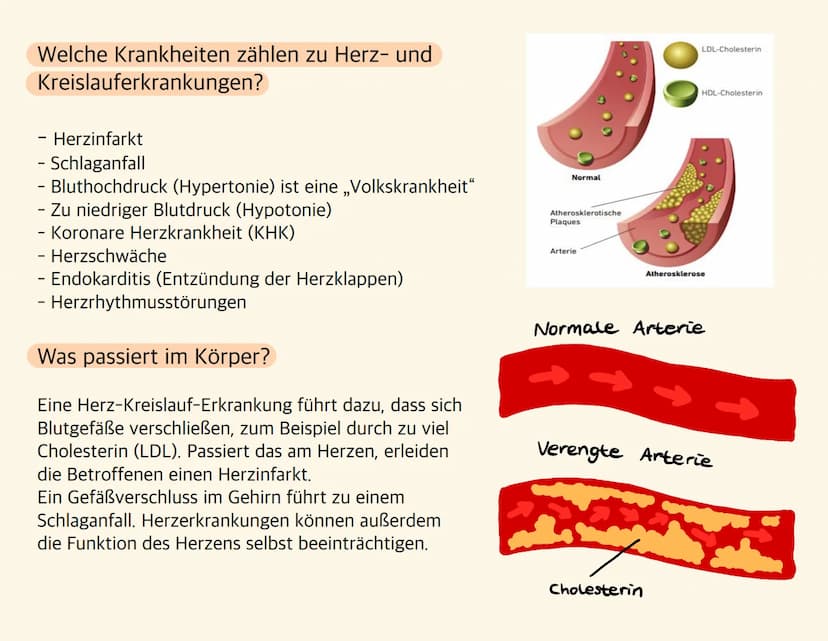 Herz-Kreislauf-
Erkrankungen Welche Krankheiten zählen zu Herz- und
Kreislauferkrankungen?
- Herzinfarkt
- Schlaganfall
- Bluthochdruck (Hyp