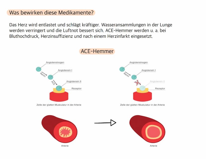 Herz-Kreislauf-
Erkrankungen Welche Krankheiten zählen zu Herz- und
Kreislauferkrankungen?
- Herzinfarkt
- Schlaganfall
- Bluthochdruck (Hyp