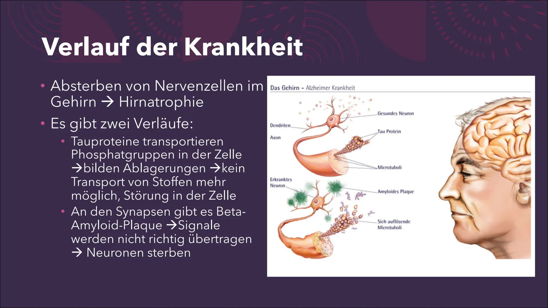 (Morbus) Alzheimer
Eine Präsentation von Emma Sundt und
Kinga Janecki
STUD
176 17
MA 18
RFP
5cm
RI
TPi
SP H44 5 TR 6300.0
SL 5.0 LTE 124.0
C