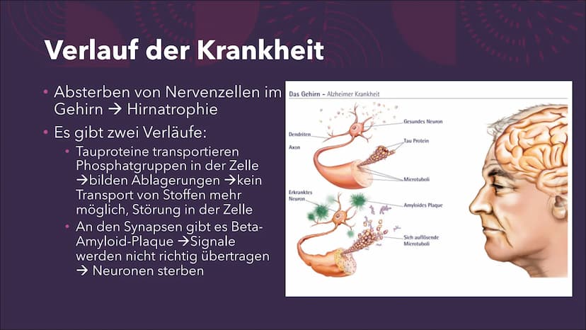 (Morbus) Alzheimer
Eine Präsentation von Emma Sundt und
Kinga Janecki
STUD
176 17
MA 18
RFP
5cm
RI
TPi
SP H44 5 TR 6300.0
SL 5.0 LTE 124.0
C