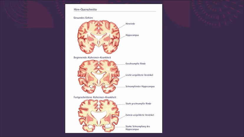 (Morbus) Alzheimer
Eine Präsentation von Emma Sundt und
Kinga Janecki
STUD
176 17
MA 18
RFP
5cm
RI
TPi
SP H44 5 TR 6300.0
SL 5.0 LTE 124.0
C