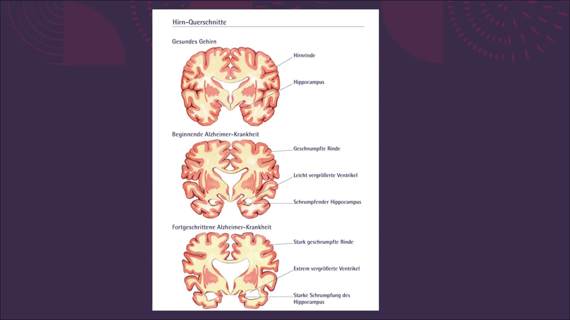 (Morbus) Alzheimer
Eine Präsentation von Emma Sundt und
Kinga Janecki
STUD
176 17
MA 18
RFP
5cm
RI
TPi
SP H44 5 TR 6300.0
SL 5.0 LTE 124.0
C