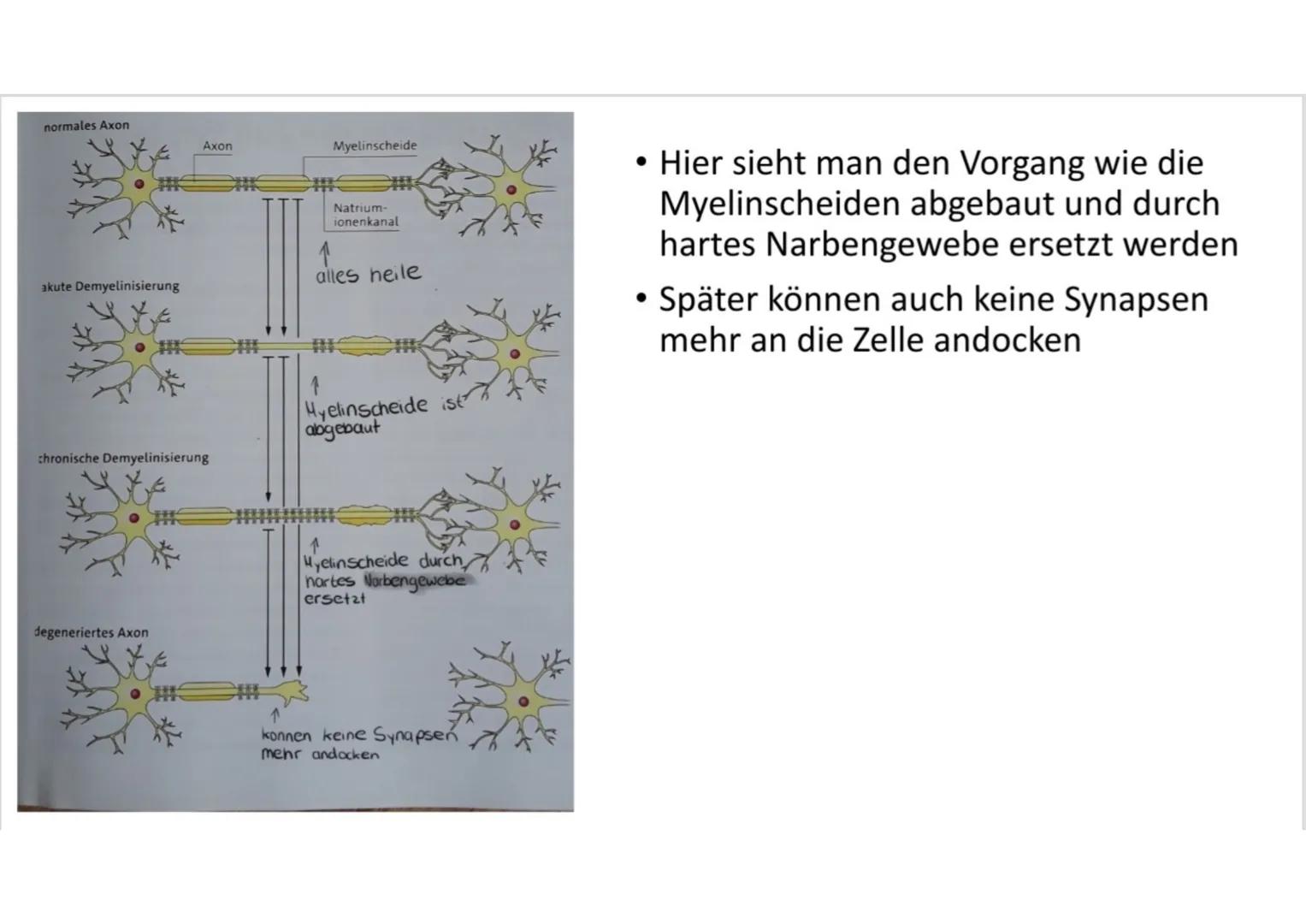 # Multiple Sklerose Inhalt

• Was ist Multiple Sklerose?
• Symptome
• Was passiert im Körper?
• Verlaufsformen # Was ist Multiple Sklerose?
