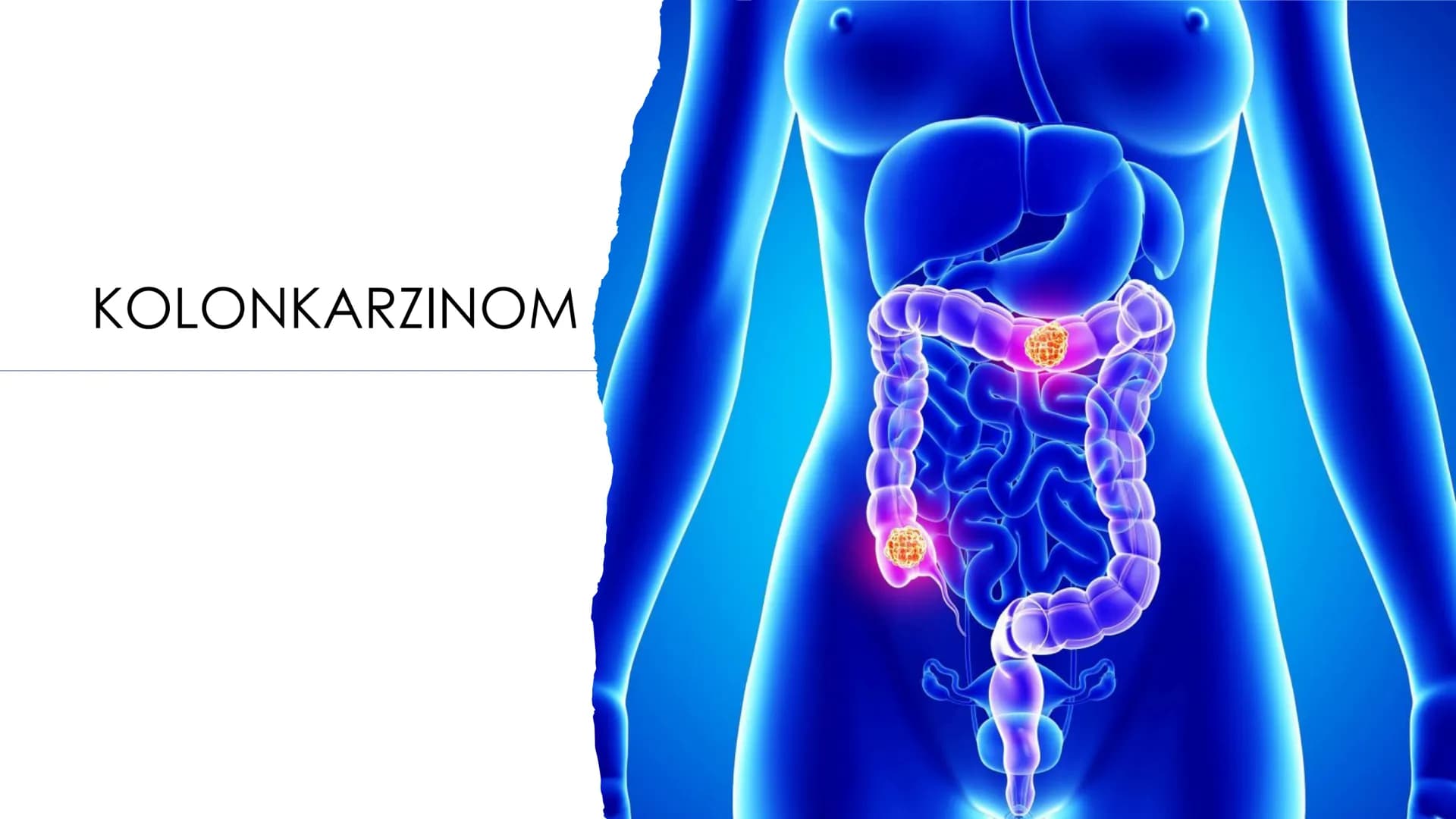 KOLONKARZINOM
G ●
●
●
●
Definition
Karzinom: bösartige Wucherung der Schleimhaut
Kolonkarzinom: Tumoren die zwischen Blinddarm und dem Begin