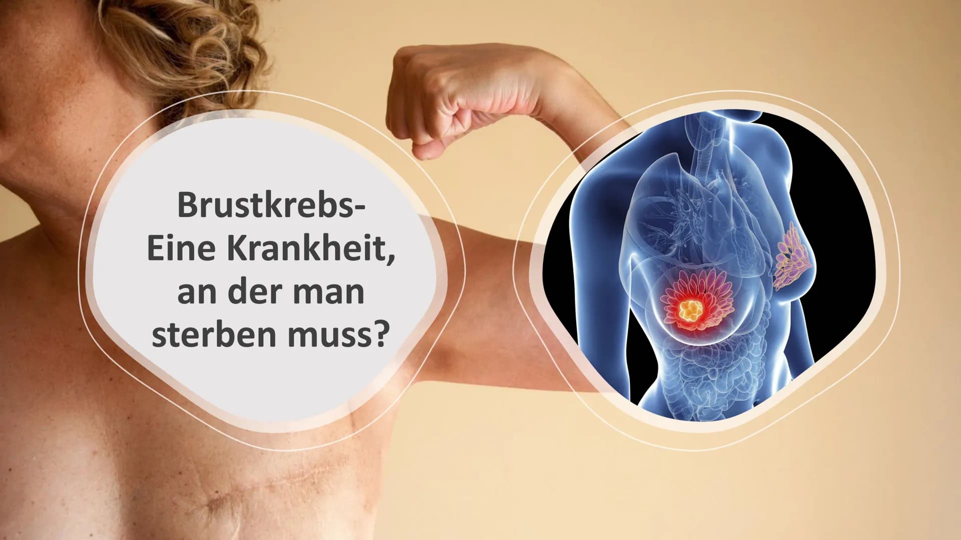 Brustkrebs-
Eine Krankheit,
an der man
sterben muss? Gliederung
1 Mammakarzinom
2 Risikofaktoren
3 Brustkrebs-Früherkennung
4 Mutation von B