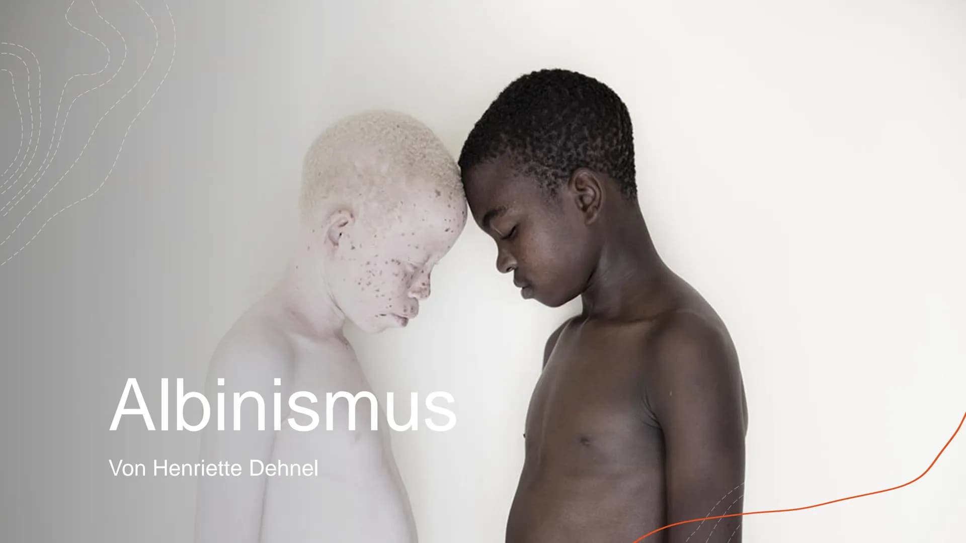 Albinismus
Von Henriette Dehnel Gliederung
Allgemeines
o Melanin
o Erbgang
o Phänotyp und Symptome
Formen des Albinismus
o Diagnose
o Therap