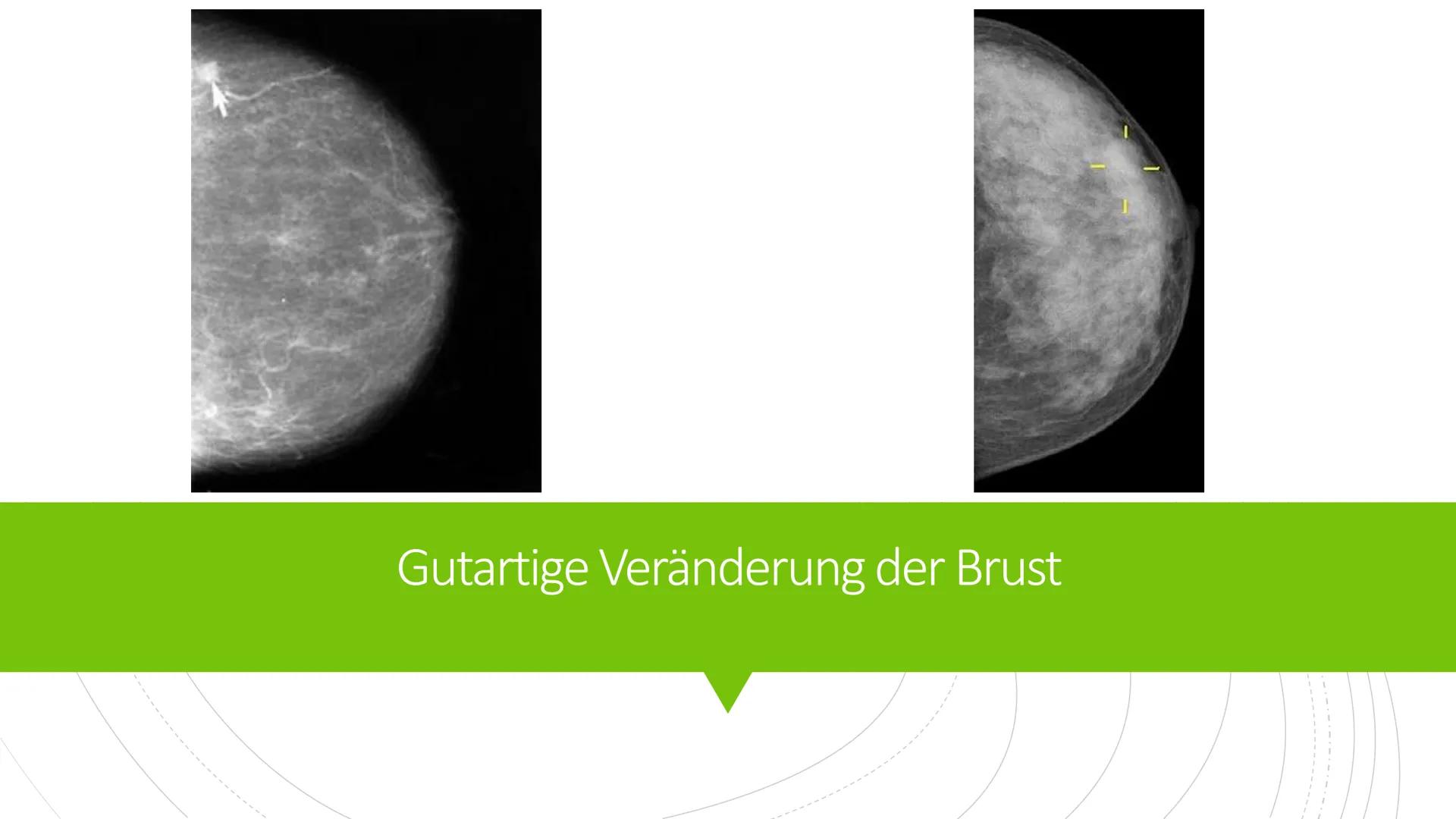 Brustkrebs
Knowunity@matura2021 Was ist Brustkrebs?
■ medizinisch Mammakarzinom
bösartige Veränderung des Brustgewebes
hauptsächlich bei Fra