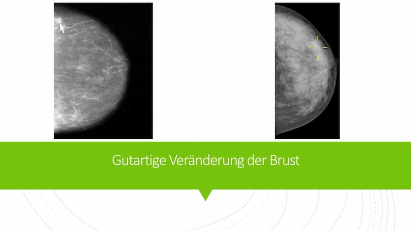Brustkrebs
Knowunity@matura2021 Was ist Brustkrebs?
■ medizinisch Mammakarzinom
bösartige Veränderung des Brustgewebes
hauptsächlich bei Fra