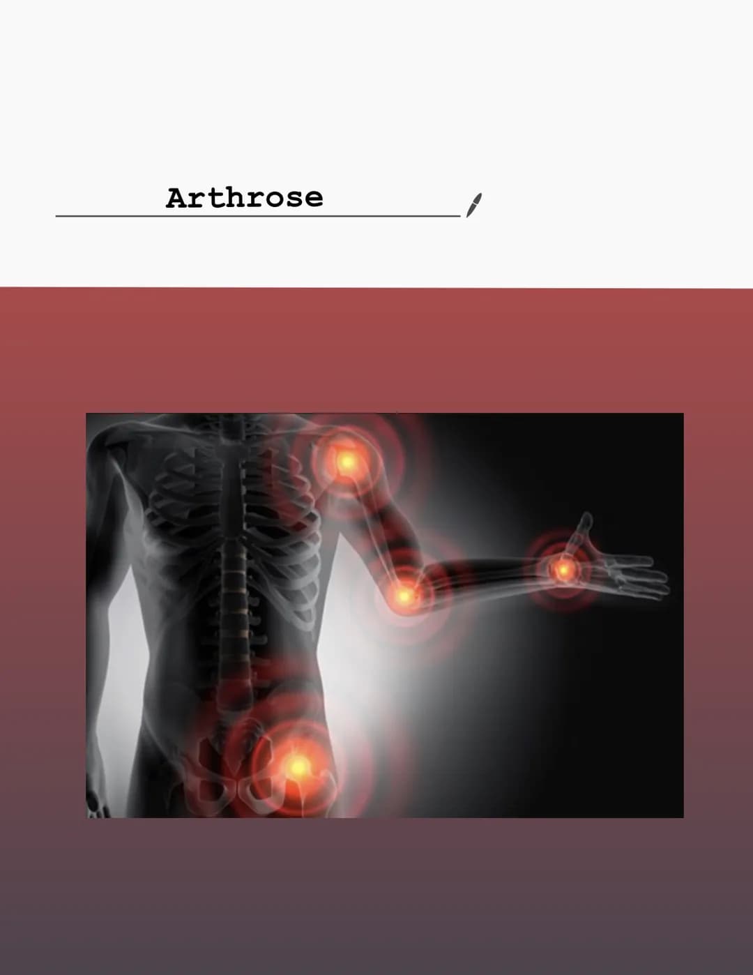 Arthrose Definition
Normal
Kapsel
吧
Knorpel
Synovialis
(Schleimhaut-
schicht)
Knochen
OQQ
Degenerative Erkrankung eines o. mehrerer
Gelenke.