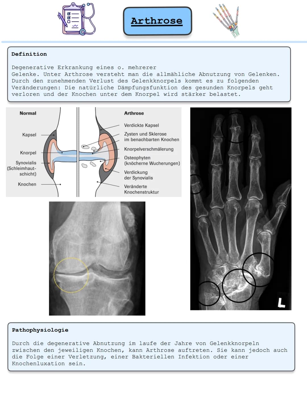 Arthrose Definition
Normal
Kapsel
吧
Knorpel
Synovialis
(Schleimhaut-
schicht)
Knochen
OQQ
Degenerative Erkrankung eines o. mehrerer
Gelenke.