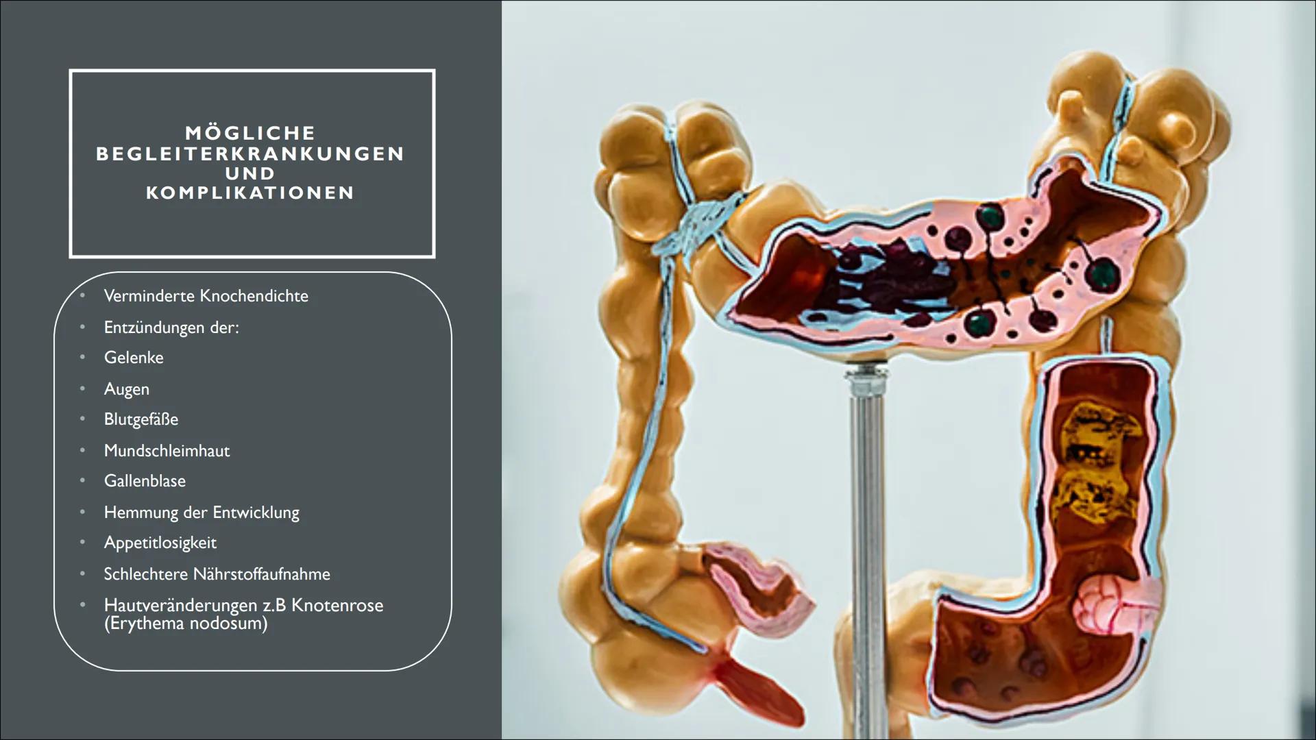 ENTZÜNDLICHE DARMERKRANKUNG
MORBUS CROHN -
em
pee INHALTSVERZEICHNIS
1) Definition
2) Beschreibung der Krankheit
3) Ursachen und Risikofakto