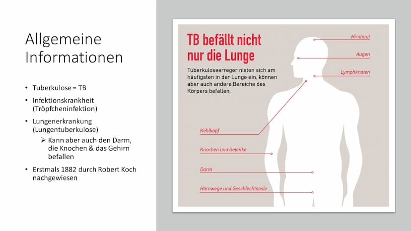 TUBERKULOSE
Eine weltweite Bedrohung Inhalt
●
●
• Symptome Bespiele
●
●
●
●
●
Allgemeine Informationen
Krankheitssymptome & Diagnose
●
Krank