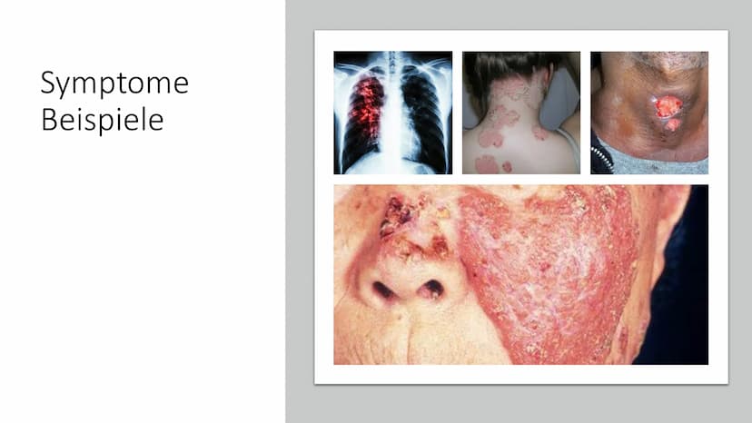 TUBERKULOSE
Eine weltweite Bedrohung Inhalt
●
●
• Symptome Bespiele
●
●
●
●
●
Allgemeine Informationen
Krankheitssymptome & Diagnose
●
Krank