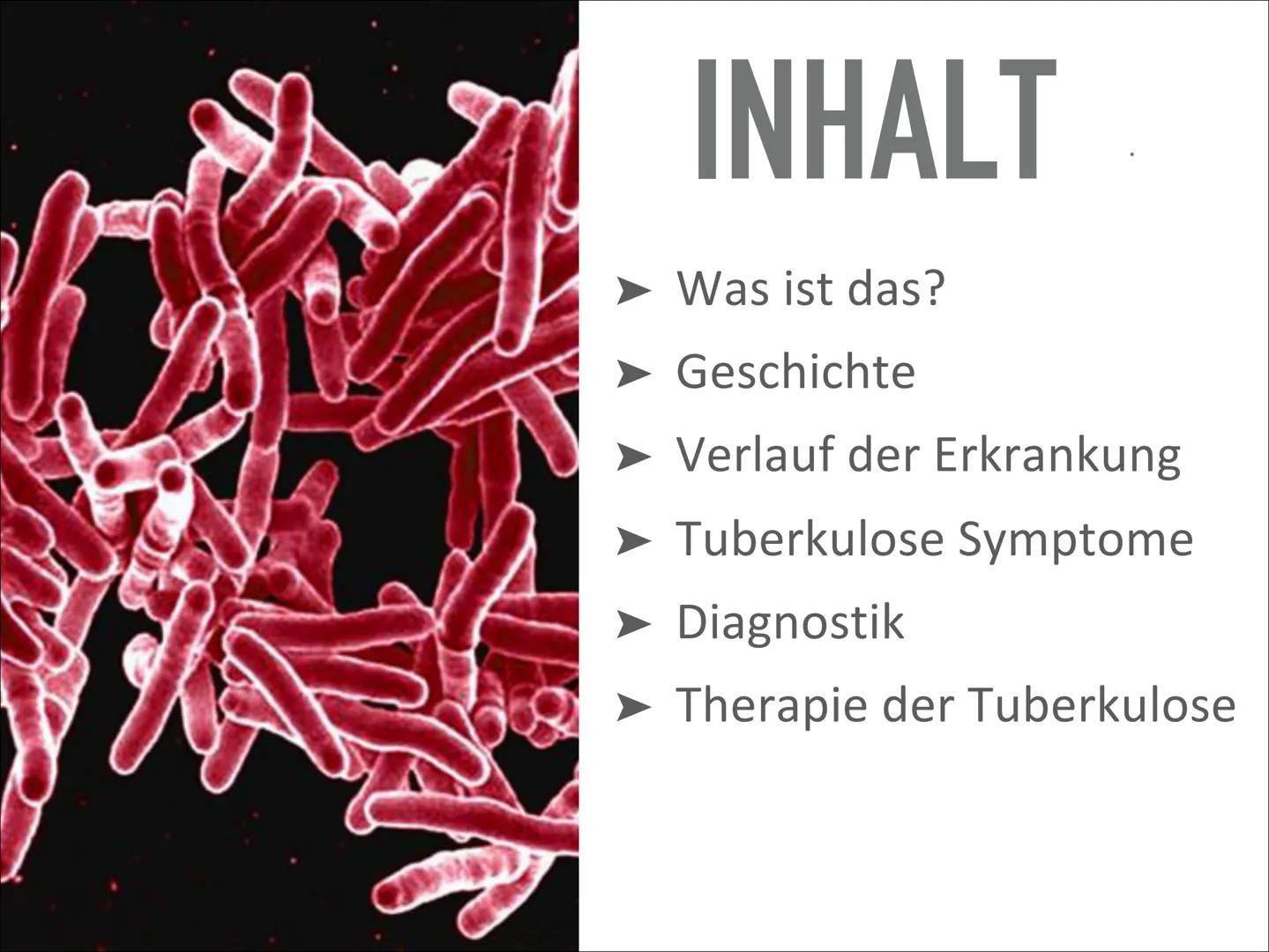 # TUBERKULOSE

Wird sich TBC wieder vermehren? Wird sich TBC wieder vermehren? # INHALT

- Was ist das?
- Geschichte
- Verlauf der Erkrankun