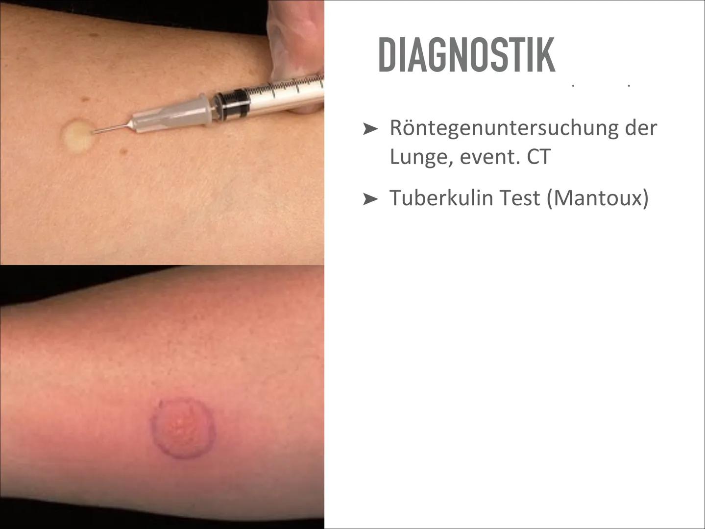 # TUBERKULOSE

Wird sich TBC wieder vermehren? Wird sich TBC wieder vermehren? # INHALT

- Was ist das?
- Geschichte
- Verlauf der Erkrankun