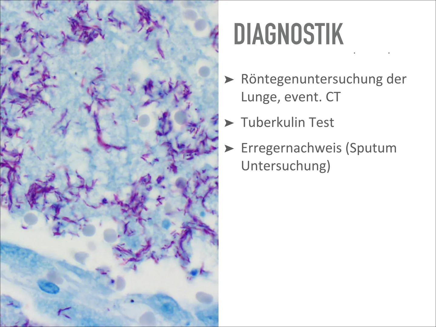 # TUBERKULOSE

Wird sich TBC wieder vermehren? Wird sich TBC wieder vermehren? # INHALT

- Was ist das?
- Geschichte
- Verlauf der Erkrankun
