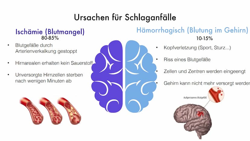 Der
Schlaganfall
Helin 10D
Biologie Gliederung
1. Was ist der Schlaganfall eigentlich?
2. Auftreten
3. Risikofaktoren
4. Ursachen
5. Symptom