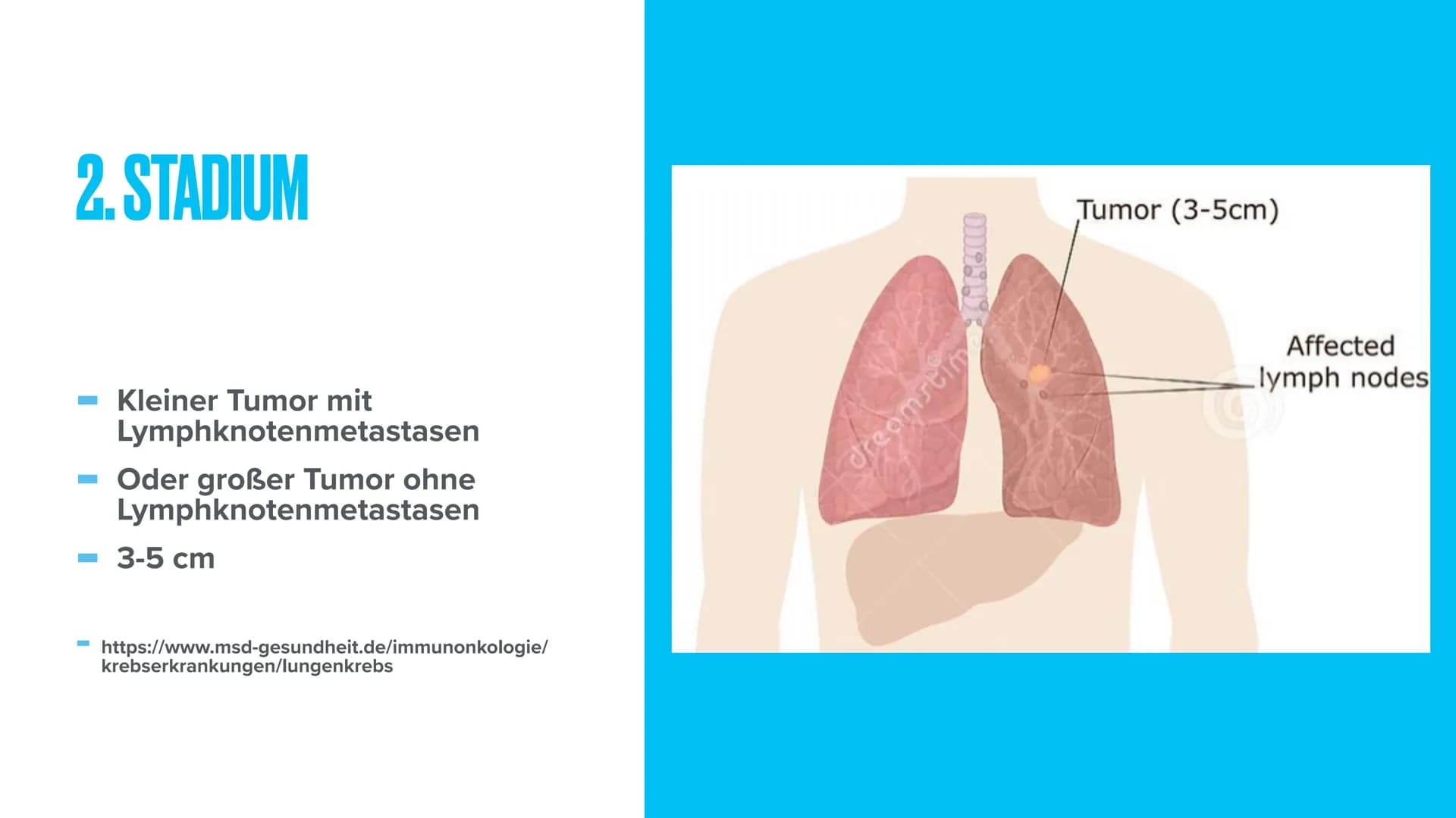 LUNGENKREBS
Biologie THEMEN
- Was ist Lungenkrebs?
Erkrankte & verstorbene in Deutschland
- Arten von Lungenkrebs
- Stadien von Lungenkrebs
