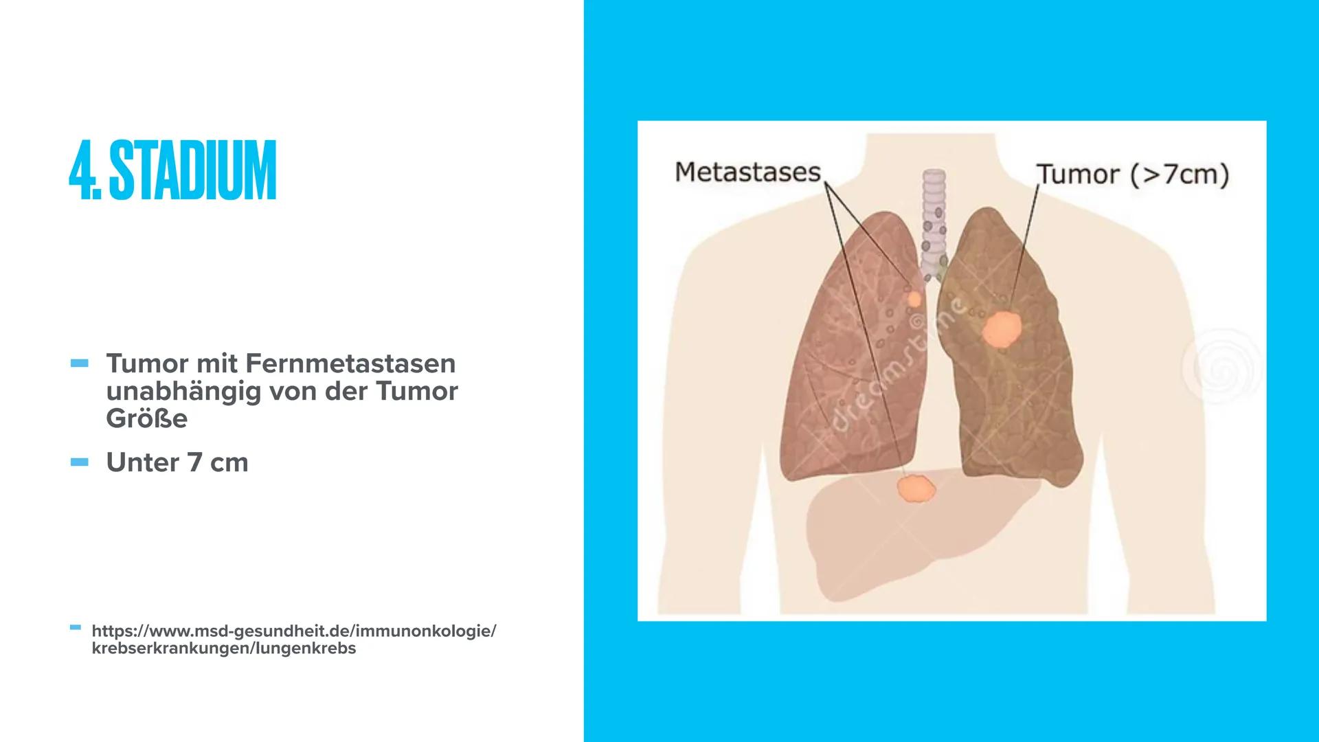 LUNGENKREBS
Biologie THEMEN
- Was ist Lungenkrebs?
Erkrankte & verstorbene in Deutschland
- Arten von Lungenkrebs
- Stadien von Lungenkrebs
