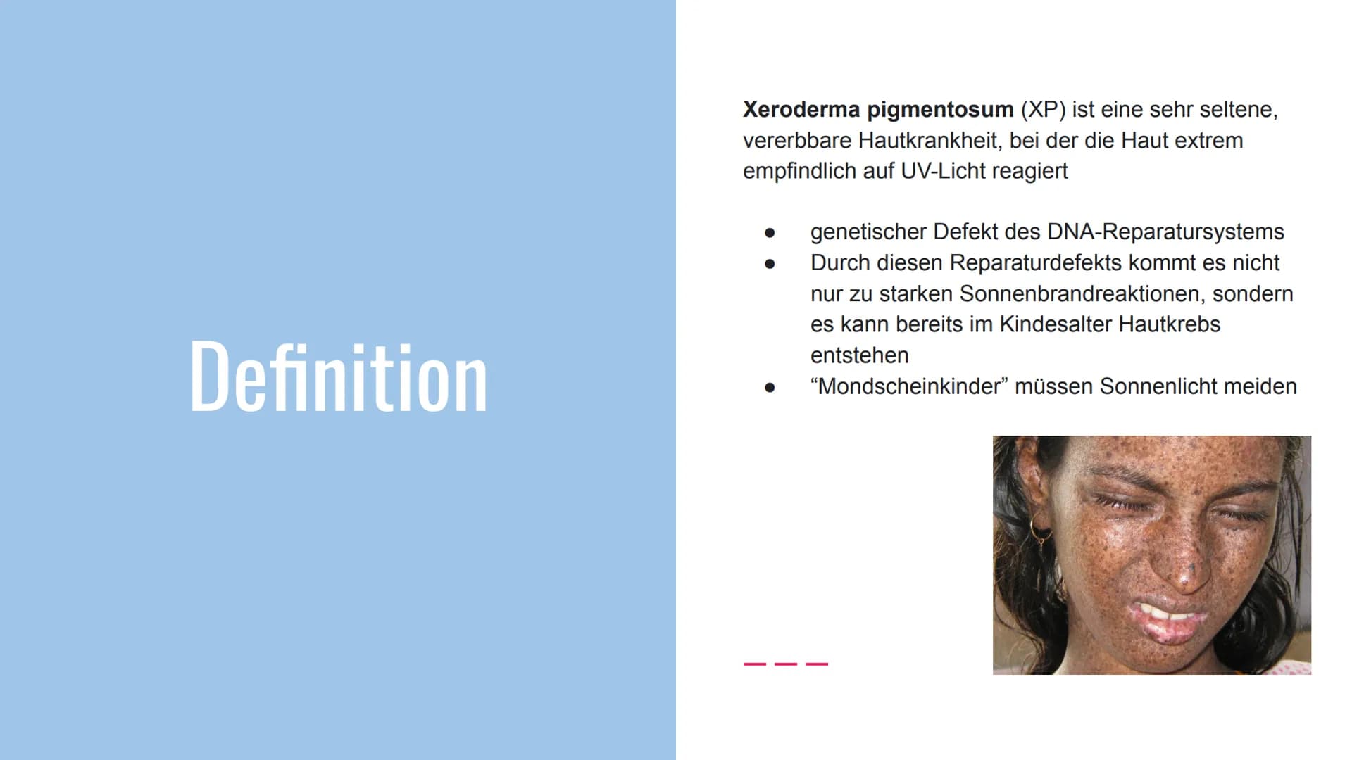 Xeroderma
Pigmentosum
(Mondscheinkran
kheit) Gliederung
Definition
• Häufigkeit
Ursachen
Symptome
Diagnose
Therapie
Was kann der Betroffene 