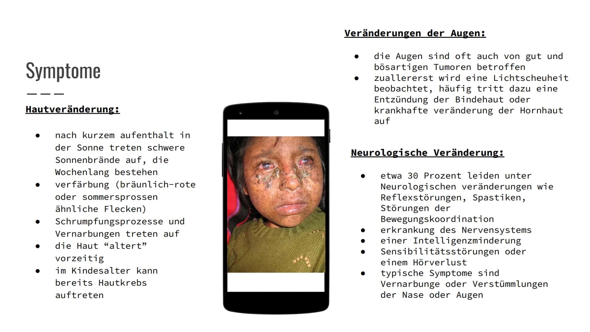 Xeroderma
Pigmentosum
(Mondscheinkran
kheit) Gliederung
Definition
• Häufigkeit
Ursachen
Symptome
Diagnose
Therapie
Was kann der Betroffene 