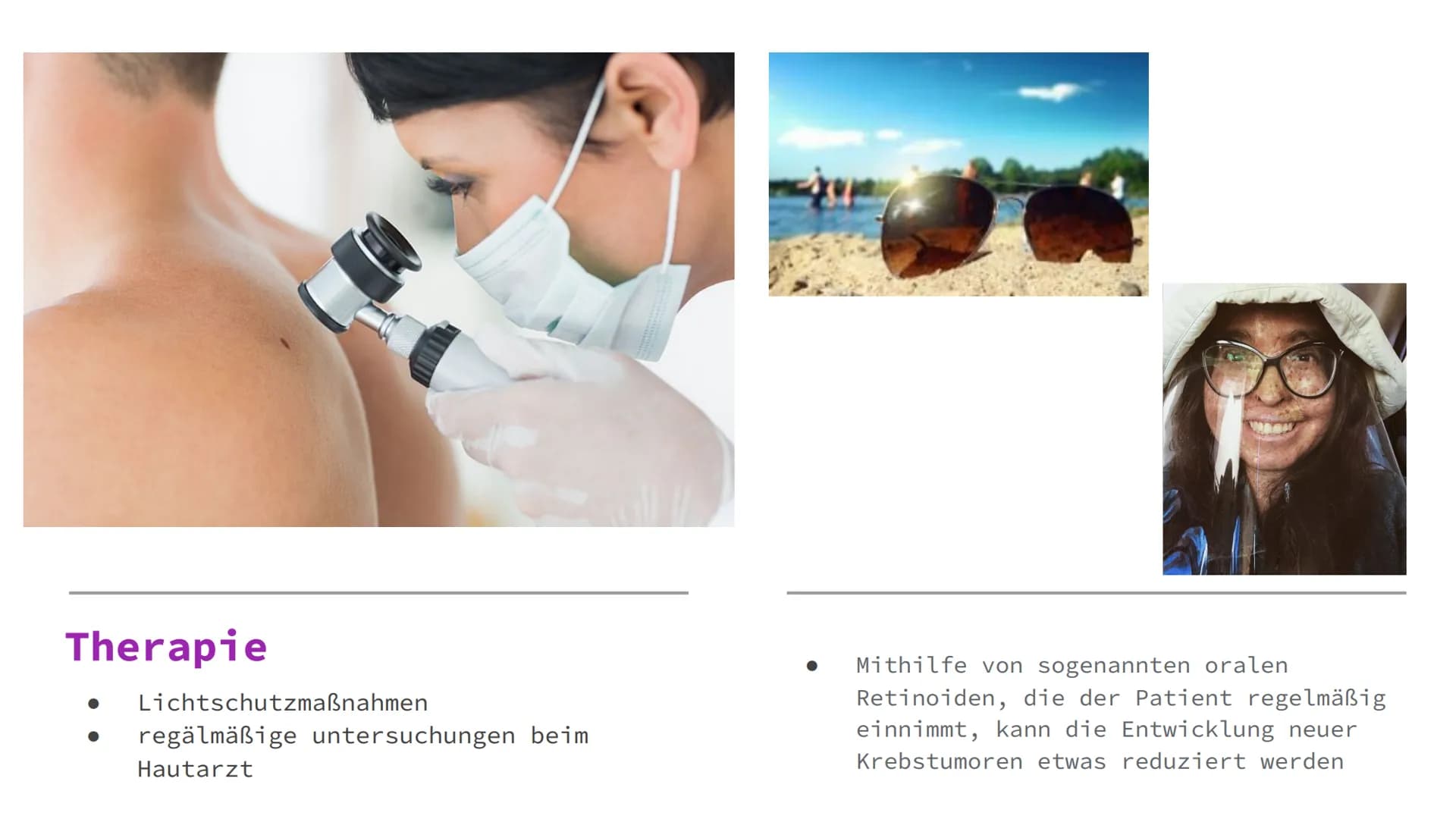 Xeroderma
Pigmentosum
(Mondscheinkran
kheit) Gliederung
Definition
• Häufigkeit
Ursachen
Symptome
Diagnose
Therapie
Was kann der Betroffene 