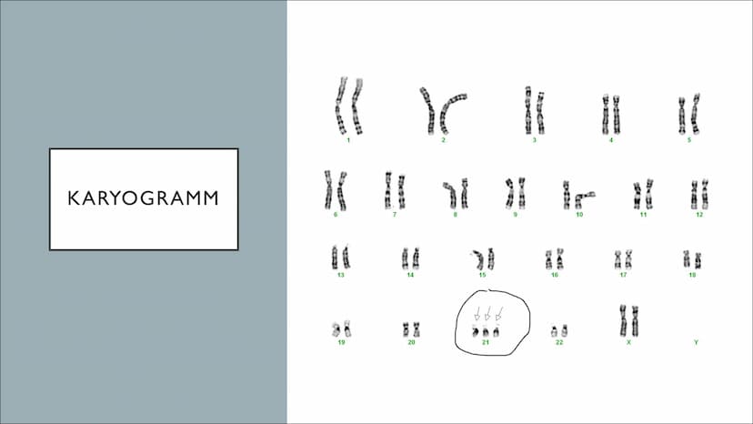Nondisjunction
Nondisjunction
in der
in der
1. meiotischen Teilung 2. meiotischen Teilung.
Sper-
mium
908)
OO
Ⓡ 0-60
trisom
monosom
trisom
e