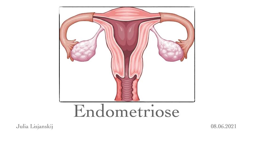 Endometriose Gynäkologie Präsentation 