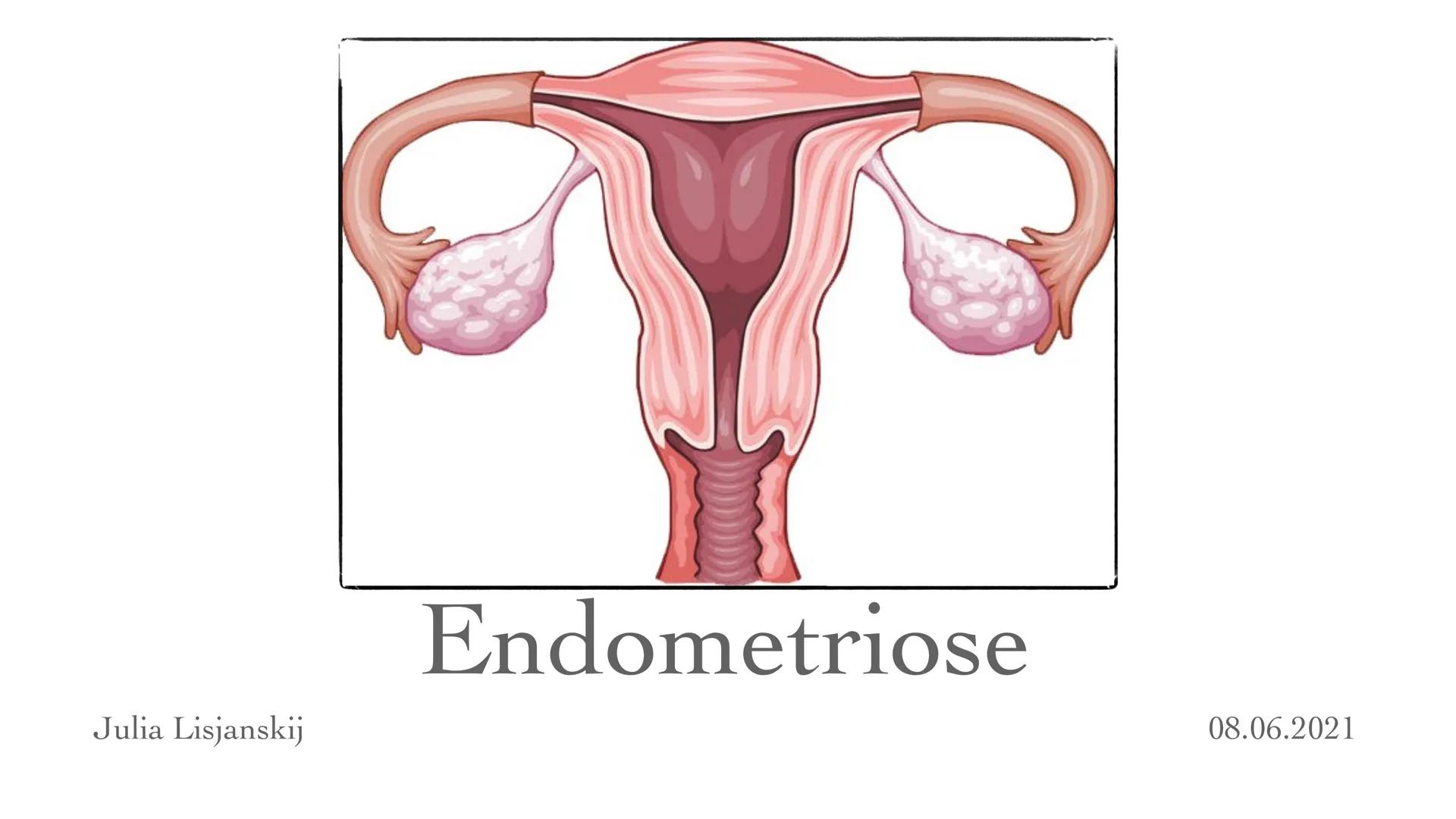 Julia Lisjanskij
Endometriose
08.06.2021 ✦ Definition
+ Beschreibung
✦ Formen
✦
Epidemiologie
Symptome
✦ Ursache
+ Risikofaktoren
Diagnose
T