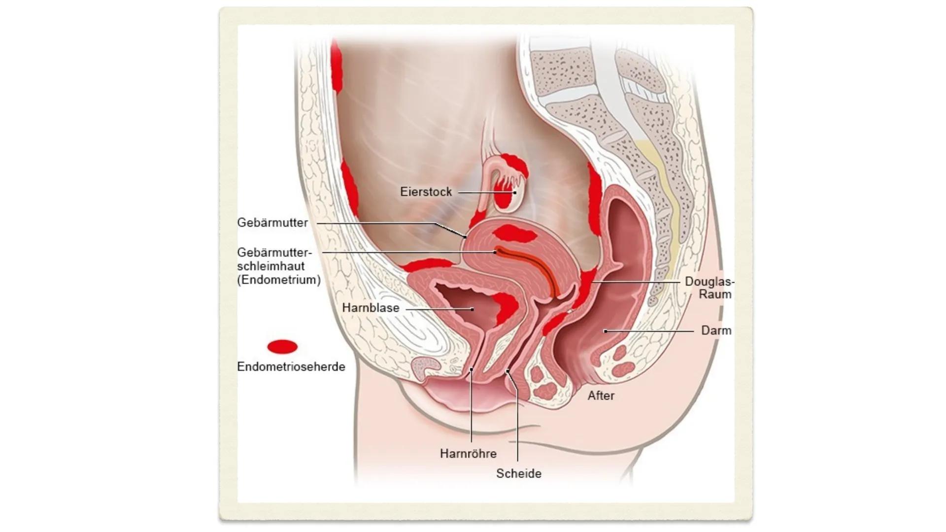 Julia Lisjanskij
Endometriose
08.06.2021 ✦ Definition
+ Beschreibung
✦ Formen
✦
Epidemiologie
Symptome
✦ Ursache
+ Risikofaktoren
Diagnose
T