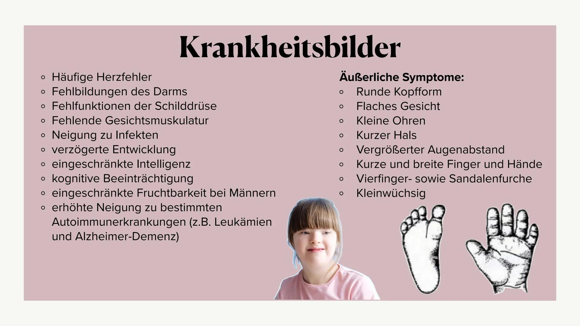 Das
DOWN-
SYNDROM Gliederung
o Was ist das Down-Syndrom?
• Ursache
• Entdeckung
• Formen des Down-Syndroms
。 Diagnosemöglichkeiten
o Krankhe