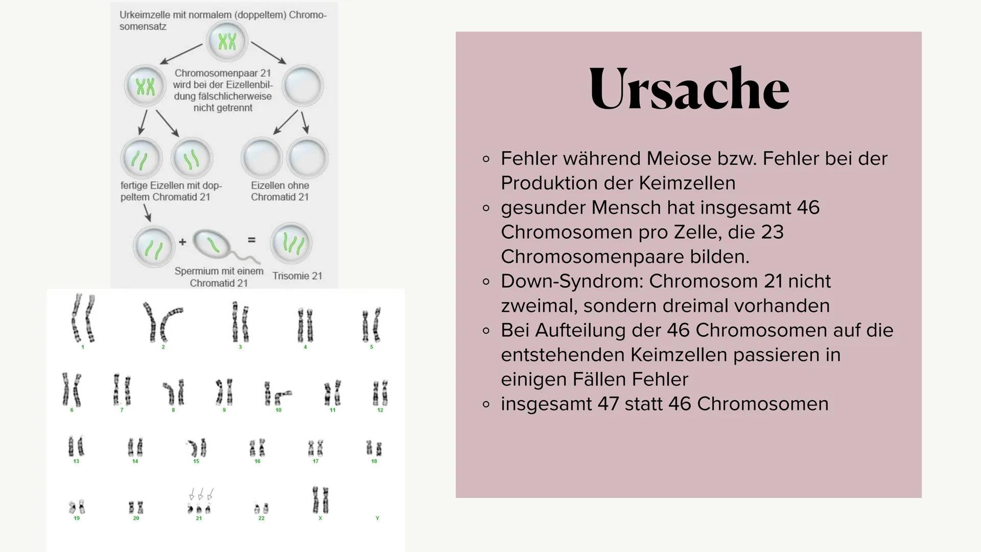 Das
DOWN-
SYNDROM Gliederung
o Was ist das Down-Syndrom?
• Ursache
• Entdeckung
• Formen des Down-Syndroms
。 Diagnosemöglichkeiten
o Krankhe