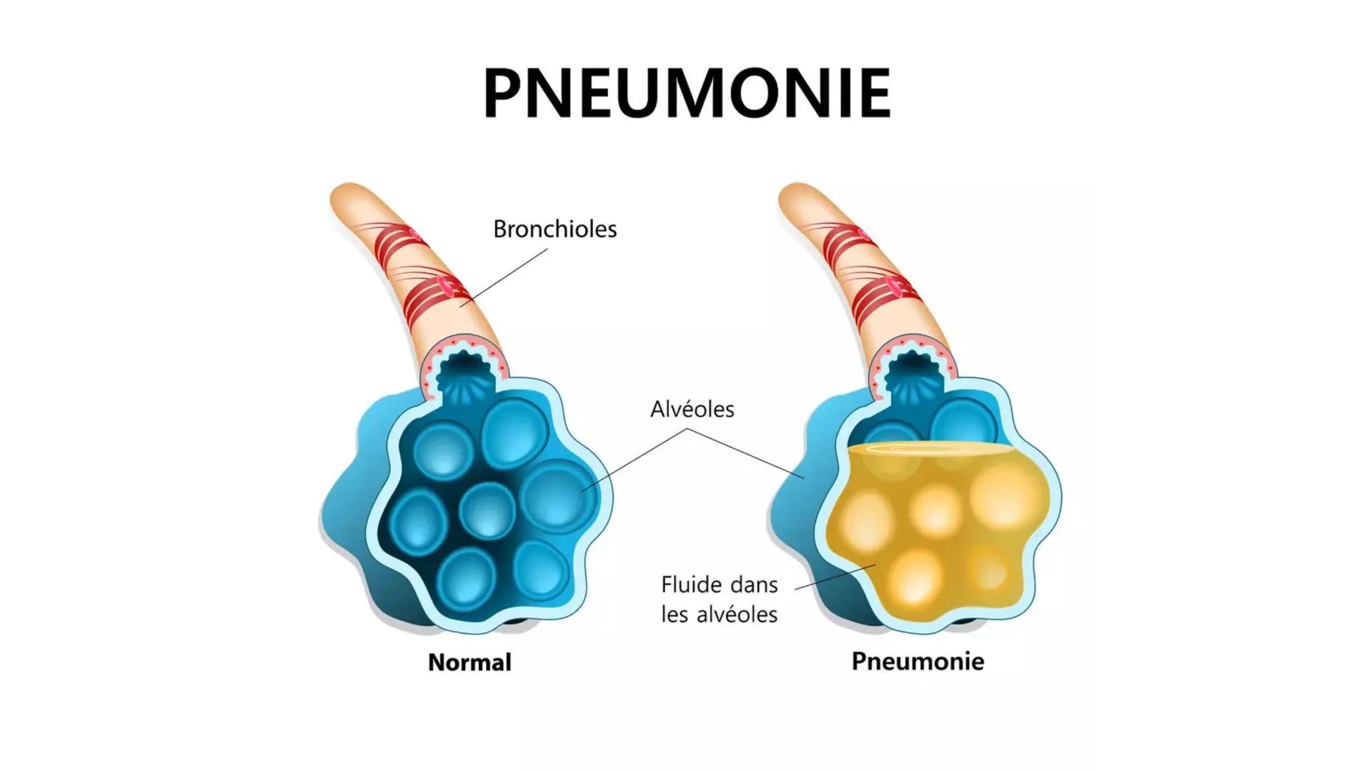 # Die Pneumonie
=Lungenentzündung # Gliederung
1. Was ist eine Pneumonie
2. Risikofaktoren
3. Symptome
4. Formen
5. Therapie & Pflege
6. Ko