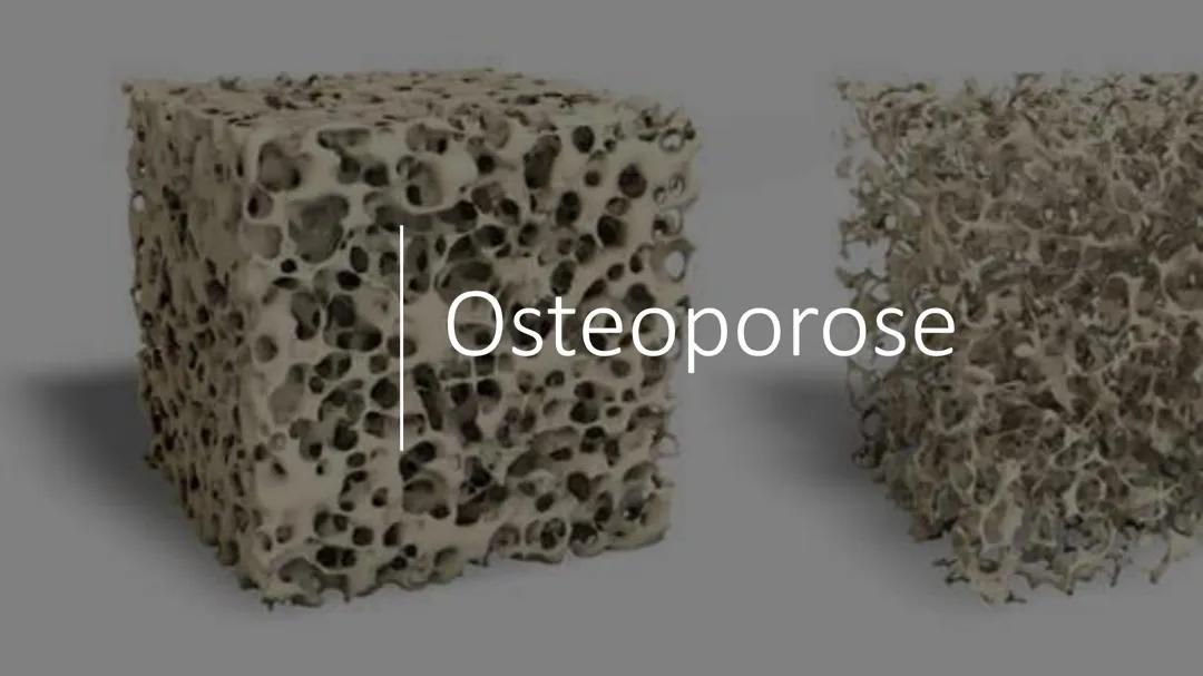 Osteoporose - Was ist das?