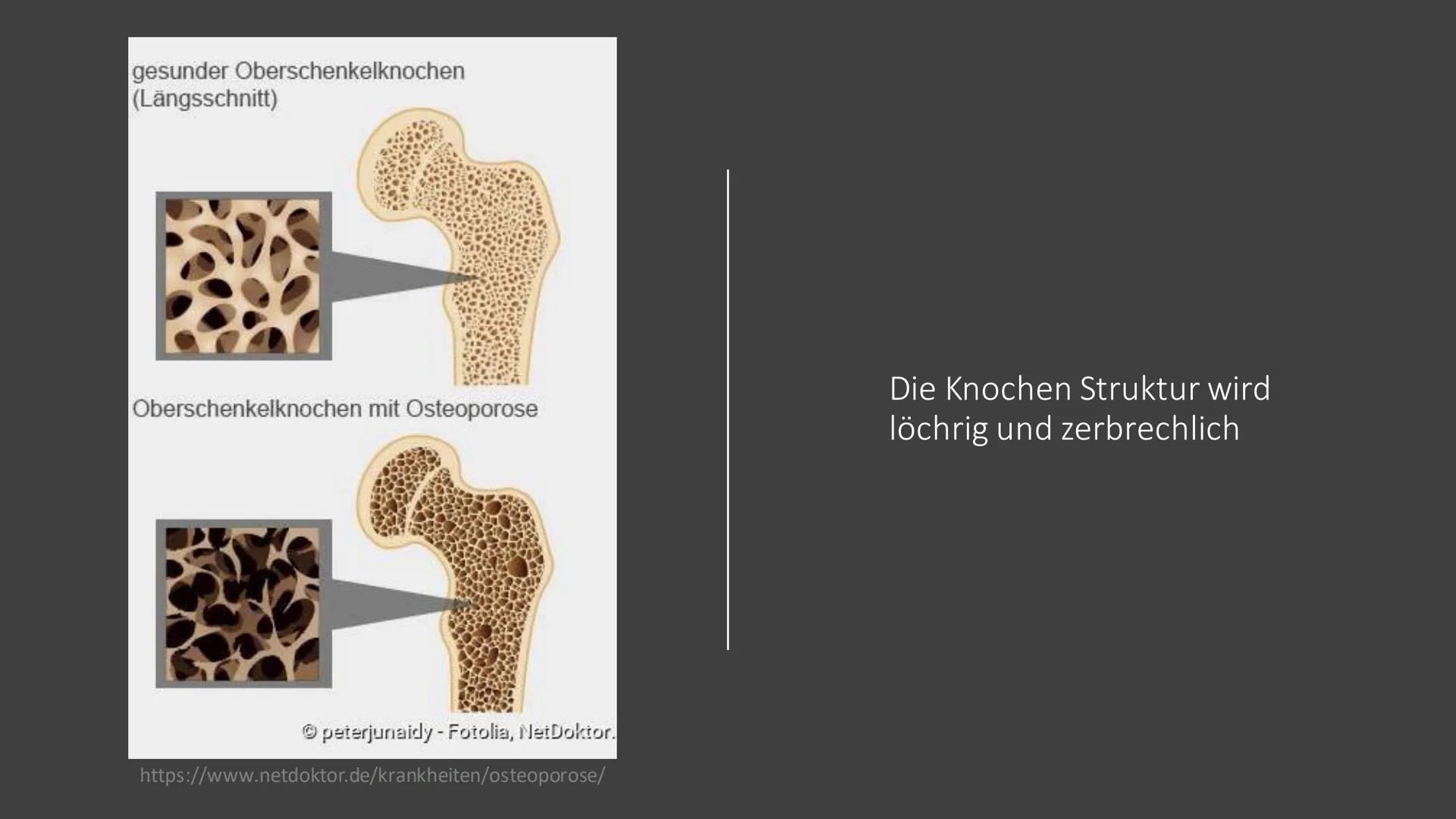 Osteoporose # Was ist Osteoporose?
https://www.osd-ev.org/osteoporose/einfuehrung/
Die Osteoporose wird gemeinhin auch als
Knochenschwund