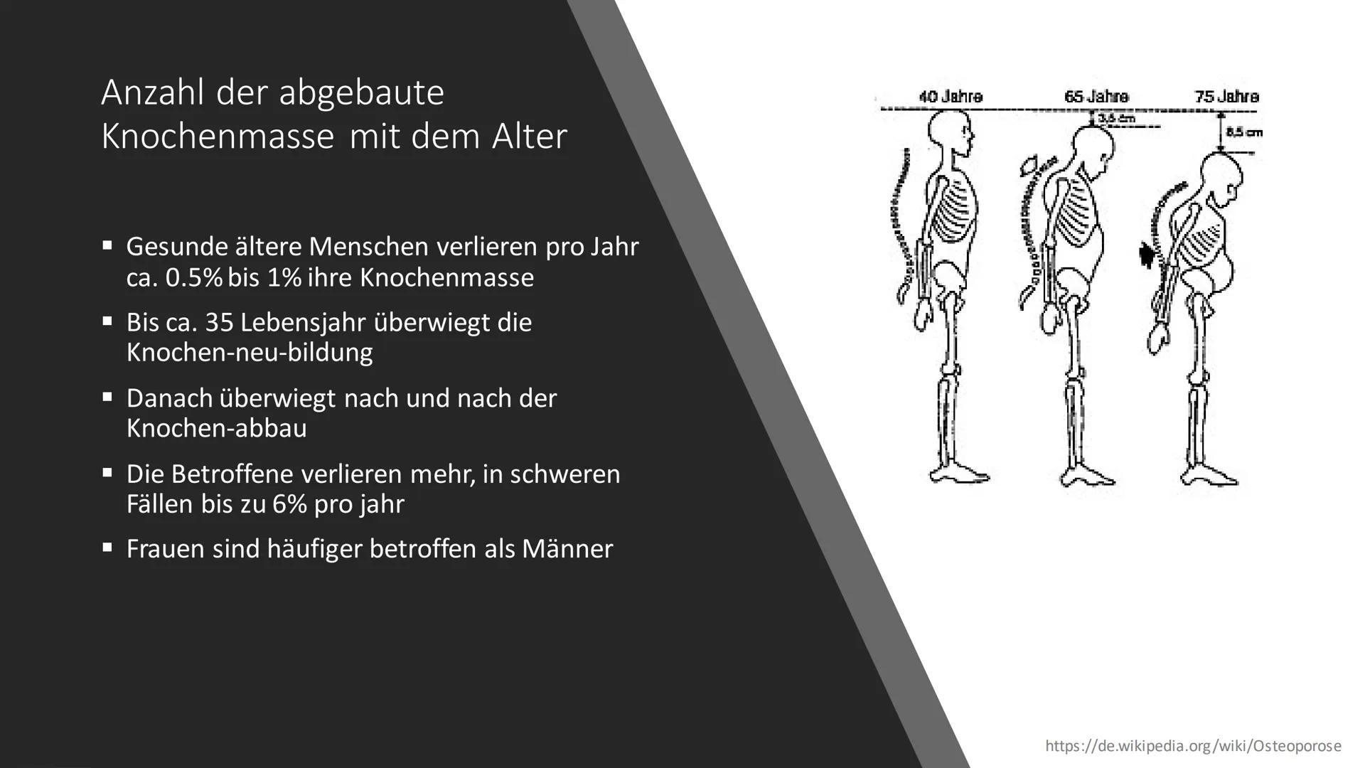 Osteoporose # Was ist Osteoporose?
https://www.osd-ev.org/osteoporose/einfuehrung/
Die Osteoporose wird gemeinhin auch als
Knochenschwund