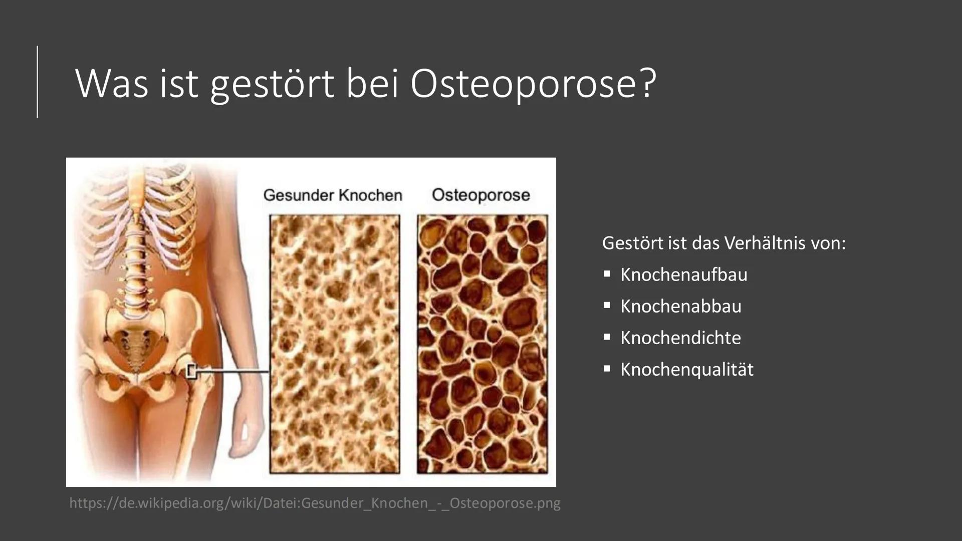 Osteoporose # Was ist Osteoporose?
https://www.osd-ev.org/osteoporose/einfuehrung/
Die Osteoporose wird gemeinhin auch als
Knochenschwund
