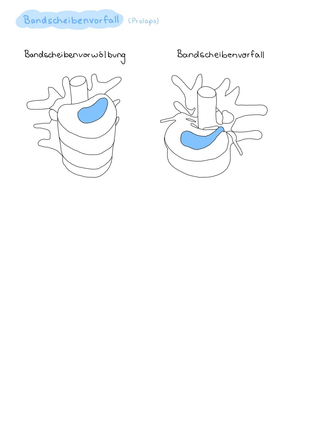 Präventinon (Bandscheiben)